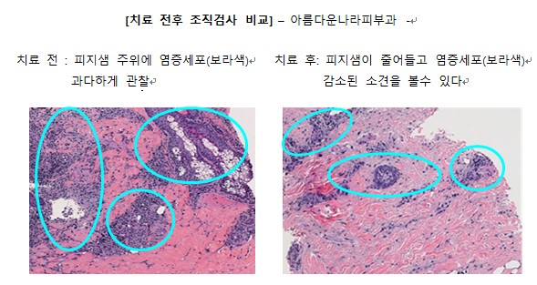 써마지 FLX·울쎄라·피코레이저 — 정품 vs 비정품 현장 구별법