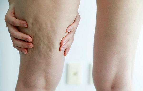 셀룰라이트 제거 방법! 원인·마사지·셀룰라이트 크림 효과까지